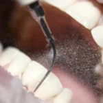 zabieg higienizacji piaskowanie w studio stomatologii estetycznej