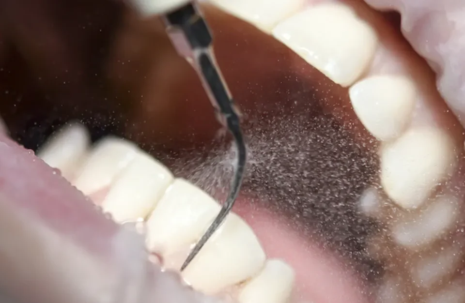 zabieg higienizacji piaskowanie w studio stomatologii estetycznej