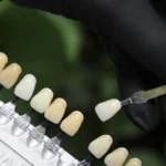 dobór koloru zębów w studio stomatologii estetycznej
