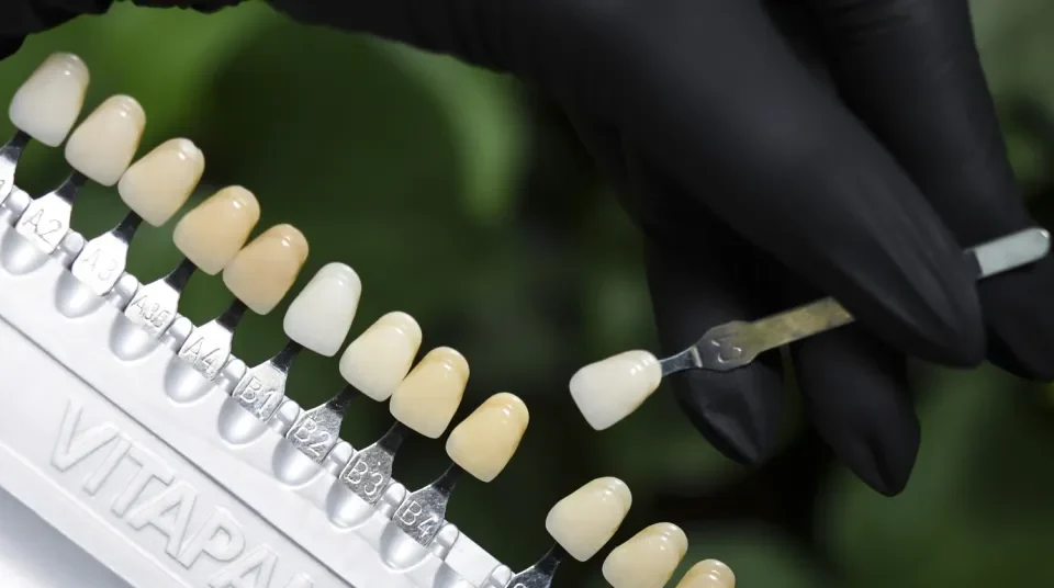 dobór koloru zębów w studio stomatologii estetycznej