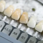 kolornik zębów w studio stomatologii estetycznej se batorego