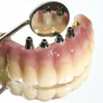 most na implantach w studio stomatologii estetycznej