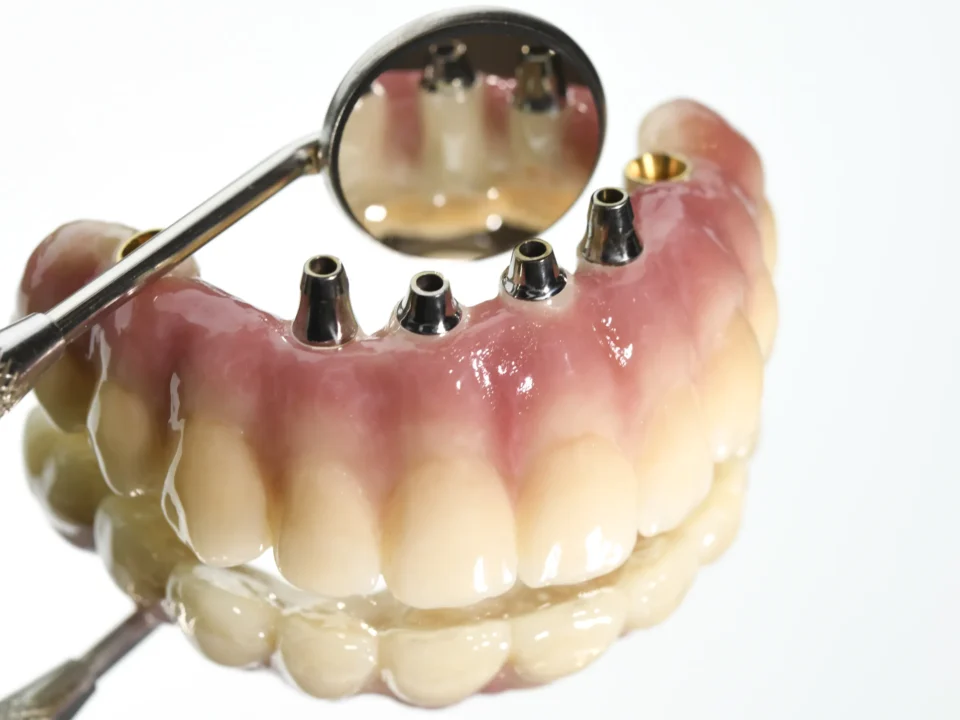 most na implantach w studio stomatologii estetycznej