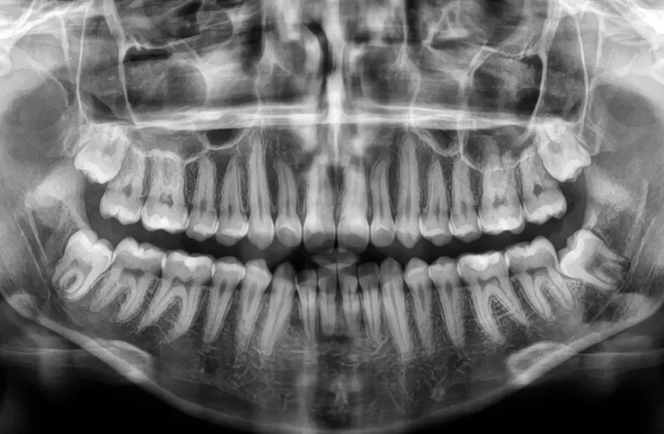 Dlaczego ludziom rosną ósemki   RTG ósemek   Studio Stomatologii Estetycznej