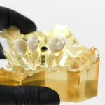 implanty zębowe wszczepiane bezboleśnie w studio stomatologii estetycznej kraków