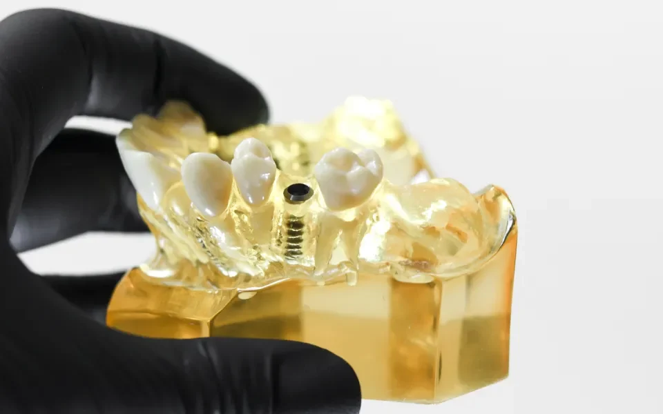 implanty zębowe wszczepiane bezboleśnie w studio stomatologii estetycznej kraków