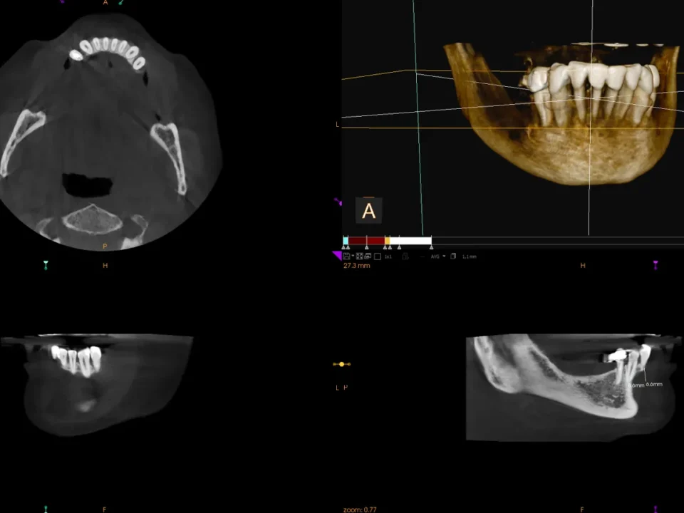 RTG 3D zębów wykonany w gabinecie dentystycznym Studio Stomatologii Estetycznej Kraków ulica Batorego