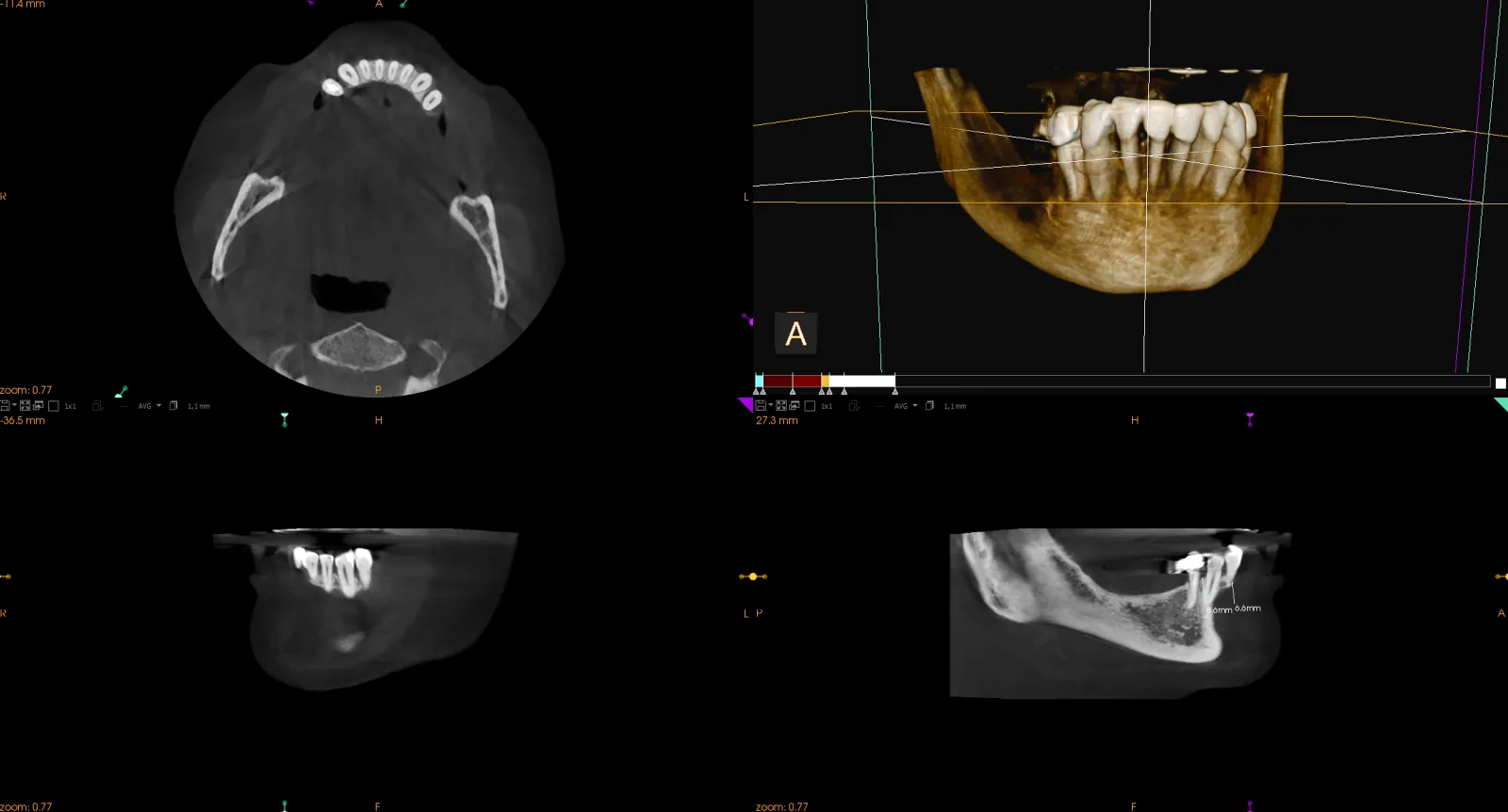 RTG 3D zębów wykonany w gabinecie dentystycznym Studio Stomatologii Estetycznej Kraków ulica Batorego