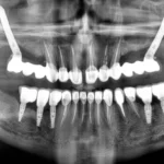 Co to są implanty zygomatyczne - zabieg i zdjęcie RTG w Studio Stomatologii Estetycznej Kraków ulica Batorego