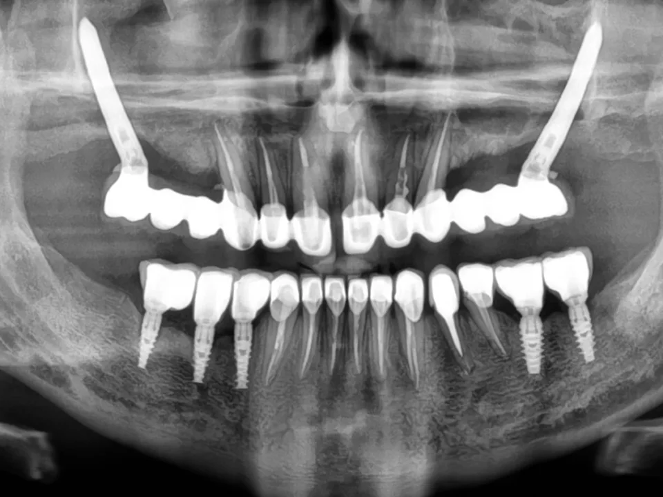 Co to są implanty zygomatyczne - zabieg i zdjęcie RTG w Studio Stomatologii Estetycznej Kraków ulica Batorego