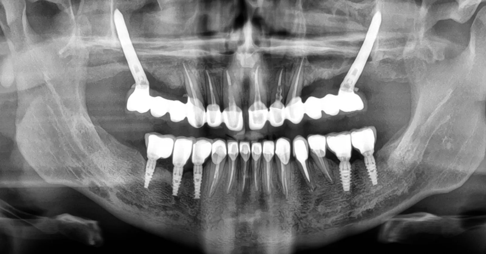 Co to są implanty zygomatyczne - zabieg i zdjęcie RTG w Studio Stomatologii Estetycznej Kraków ulica Batorego