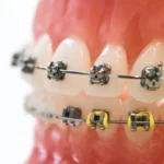 jak uchronic dziecko przed wadami zgryzu studio stomartologii estetycznej