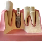 Co powoduje zanik kości szczęki lub żuchwy   Studio Stomatologii Estetycznej