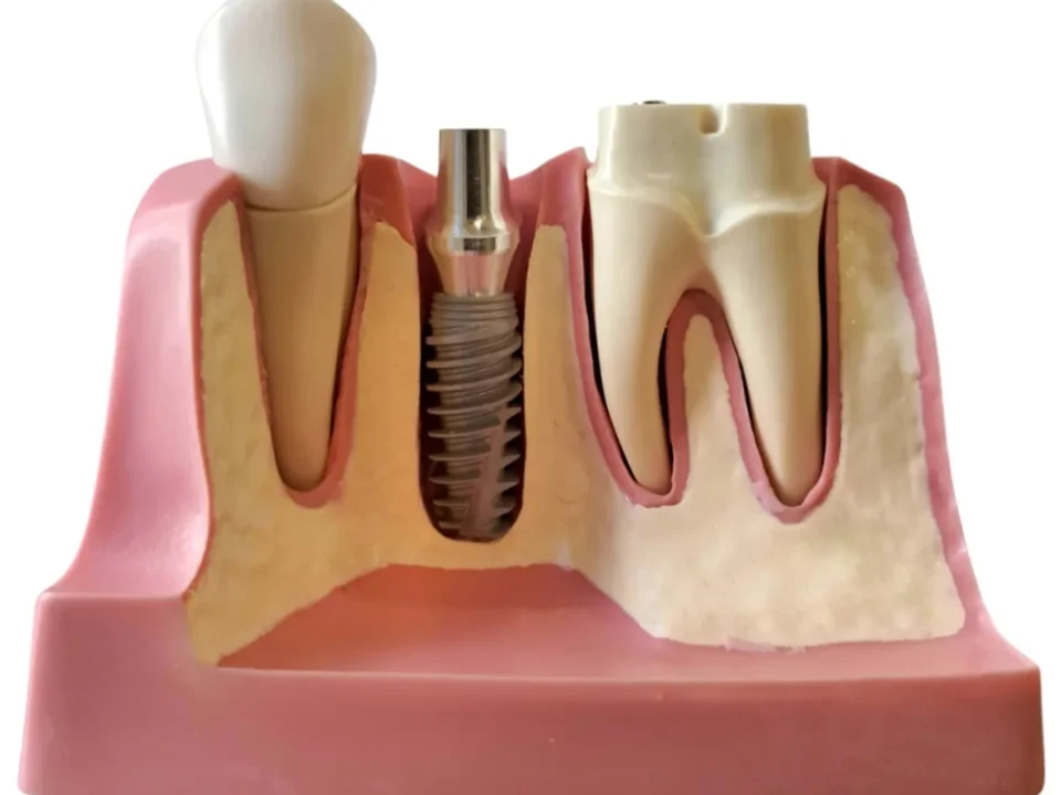 Co powoduje zanik kości szczęki lub żuchwy   Studio Stomatologii Estetycznej