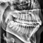 Co to jest zdjęcie cefalometryczne wykonane w gabinecie RTG - Studio Stomatologii Estetycznej