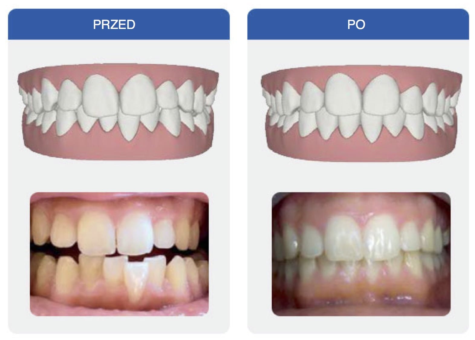 przed i po leczeniu aparatem invisalign