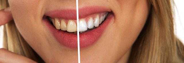 efekt przed i po wybielaniu zębów