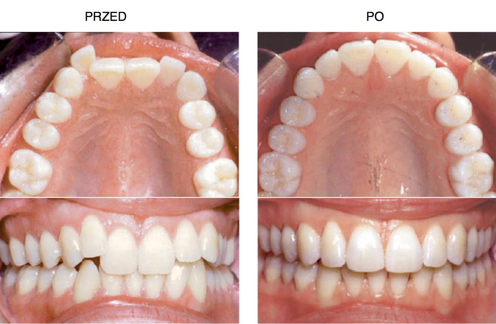 przed i po leczeniu aparatem invisalign