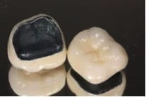 Korona porcelanowa na metalu