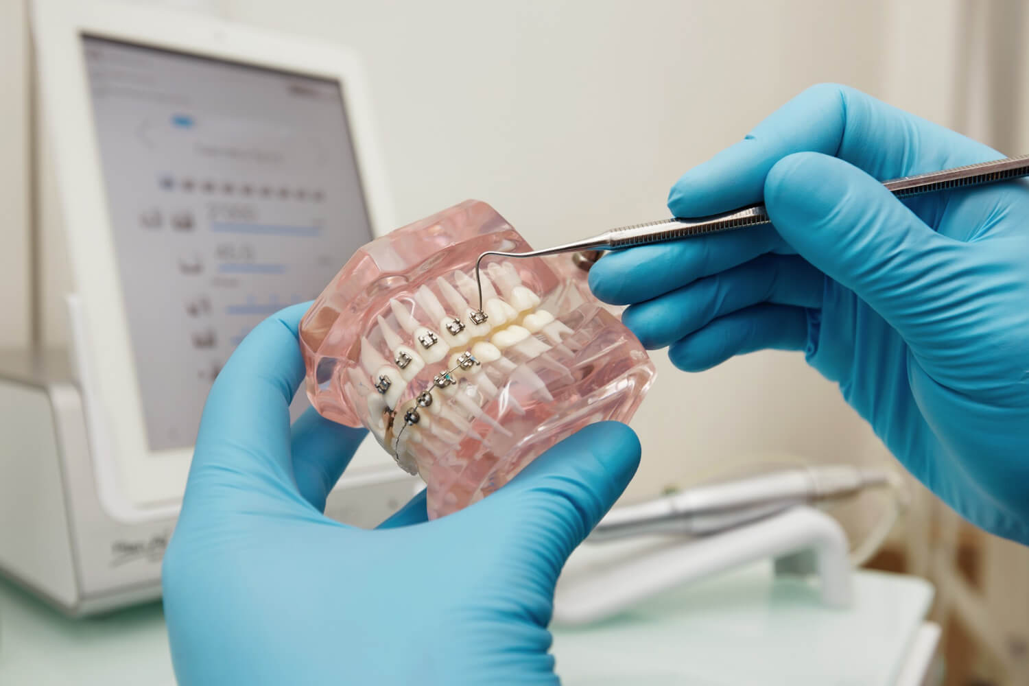 aparaty ortodontyczne zdjecie 2