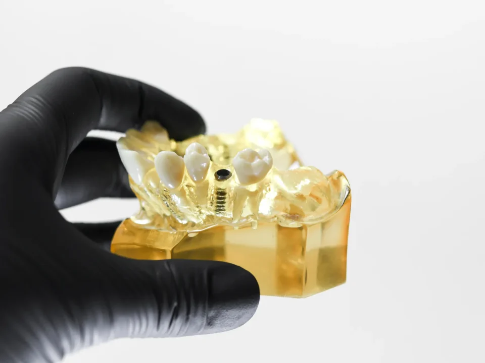 Model z implantami stomatologicznymi